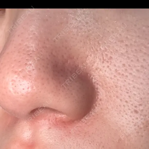 毛穴洗浄（ハイドラフェイシャルなど） 心斎橋KT美容クリニック AFTER メイン用