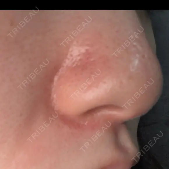 毛穴洗浄（ハイドラフェイシャルなど） 心斎橋KT美容クリニック DAY 1 メイン用