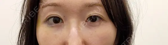 ヒアルロン酸溶解 小木曽クリニック DAY 0 メイン用