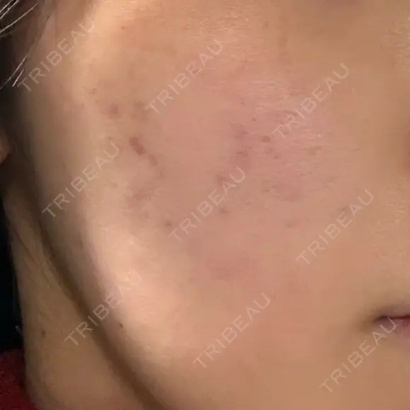 サブシジョン TRUE DESIGN CLINIC DAY 0 メイン用