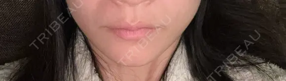 ボトックス（エラ・小顔） TCB東京中央美容外科 藤沢院 AFTER メイン用