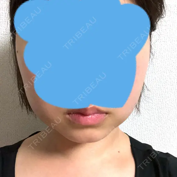 脂肪吸引（顔） GRACIA clinic 【グラシアクリニック】 DAY 22 メイン用