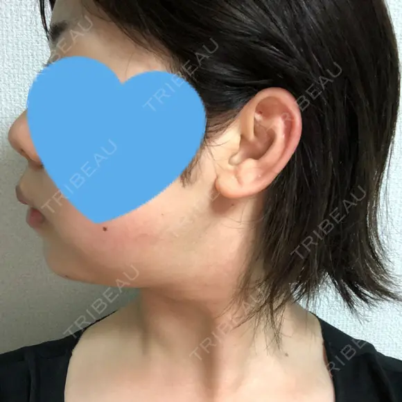 脂肪吸引（顔） GRACIA clinic 【グラシアクリニック】 DAY 22 メイン用