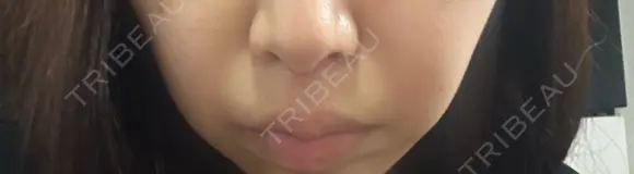 人中短縮 YBC横浜美容外科 池袋院 AFTER メイン用