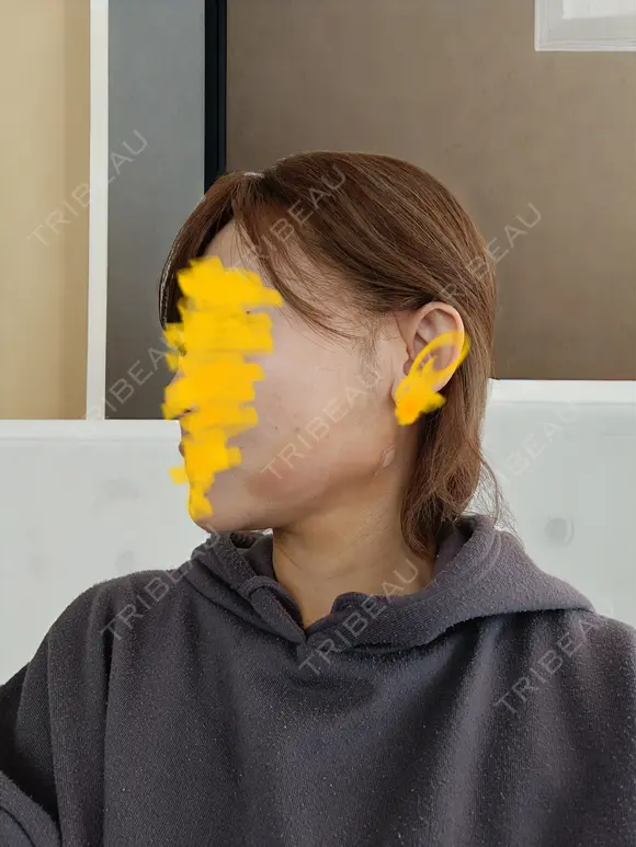 糸リフト / 脂肪吸引（顔） / ジョールファット除去 RIVER CLINIC（リバークリニック） DAY 2 メイン用