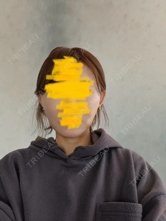 糸リフト / 脂肪吸引（顔） / ジョールファット除去 RIVER CLINIC（リバークリニック） DAY 2 メイン用