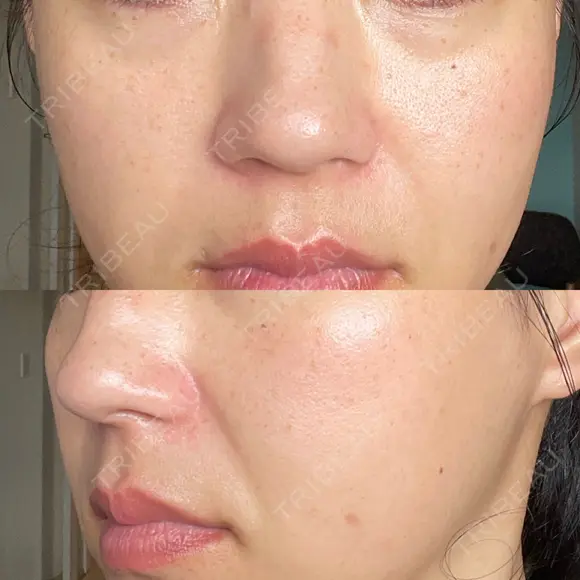 ヴェルヴェットスキン RainBoW Clinic TOKYO DAY 5 メイン用