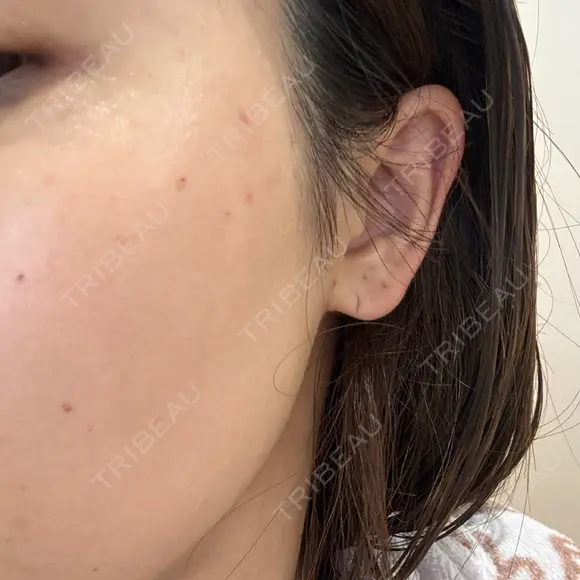 ルメッカ おおかみ美容のクリニック 新宿院 DAY 1 メイン用