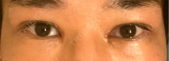 二重埋没 / 目頭切開 eクリニック 横浜みなとみらい院 DAY 30 メイン用