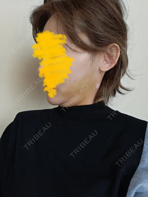 糸リフト / 脂肪吸引（顔） / ジョールファット除去 RIVER CLINIC（リバークリニック） DAY 3 メイン用