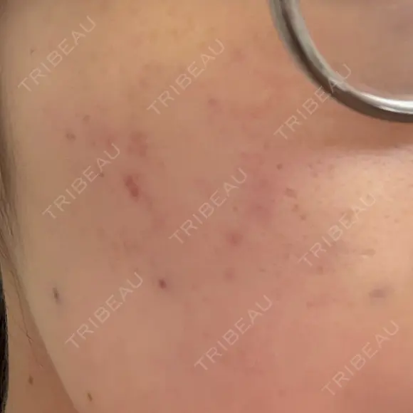 サブシジョン TRUE DESIGN CLINIC AFTER メイン用