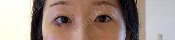 ヒアルロン酸溶解 小木曽クリニック AFTER メイン用