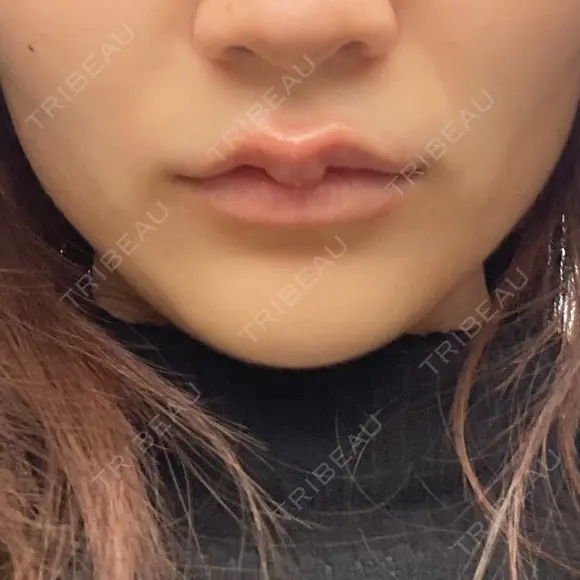 ボトックス（エラ・小顔） / ボトックス（肩） / シワ取りボトックス / ボトックス（額） BITO BEAUTY CLINIC DAY 0 メイン用