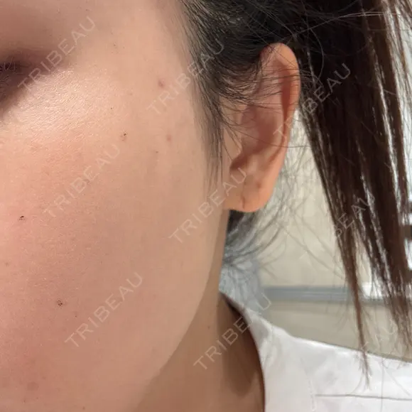 ルメッカ おおかみ美容のクリニック 新宿院 DAY 3 メイン用