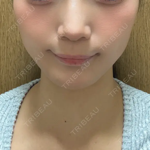 メーラーファット除去 / ハイフ（顔） A CLINIC（エークリニック） 新宿院 DAY 0 メイン用