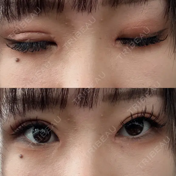 目頭切開 / 眼瞼下垂（切開） サラ美容外科 AFTER メイン用