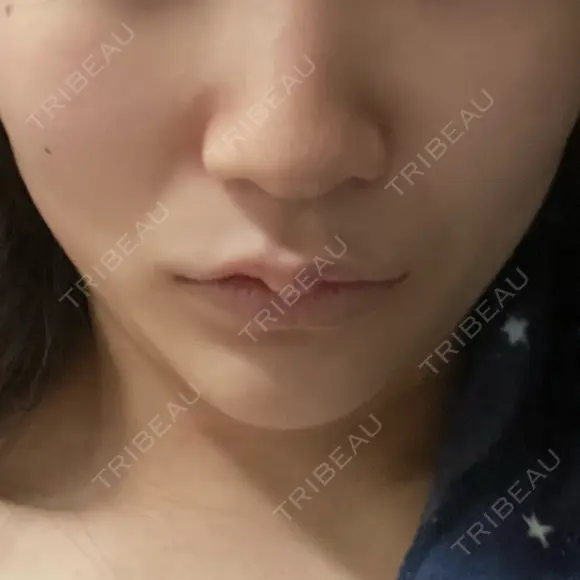 ボトックス（エラ・小顔） / ボトックス（肩） / シワ取りボトックス / ボトックス（額） BITO BEAUTY CLINIC AFTER メイン用