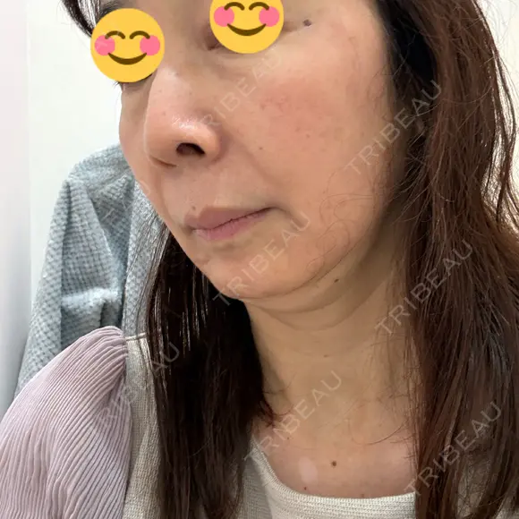 ポテンツァ BAO CLINIC 神戸院 DAY 0 メイン用