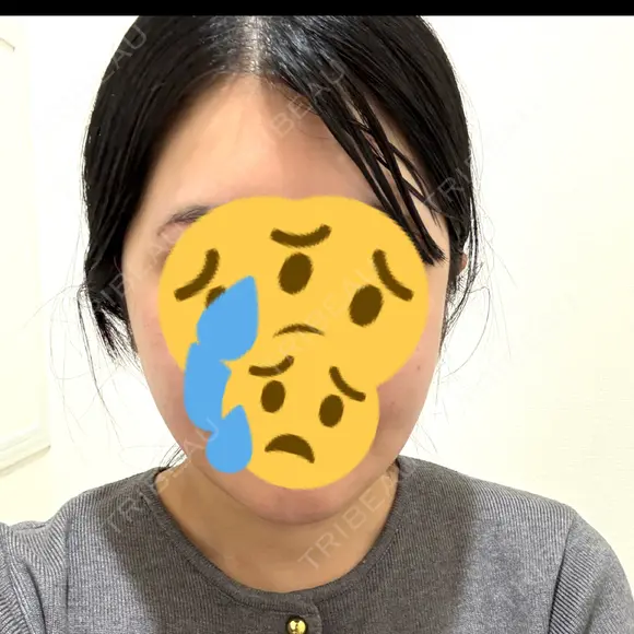 骨切り（あご） / 骨削り（エラ） / 骨削り（頬） リッツ美容外科 東京院 DAY 38 メイン用