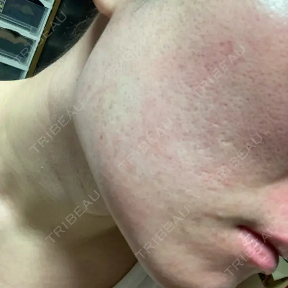 医療脱毛（顔） ZX-CLINIC 梅田院 AFTER メイン用