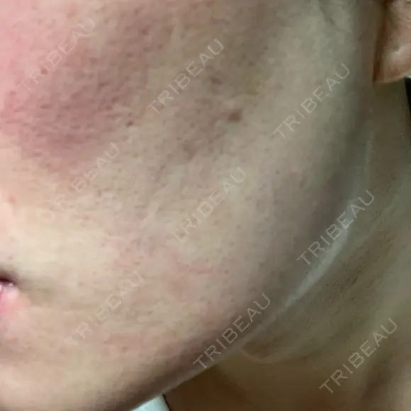 医療脱毛（顔） ZX-CLINIC 梅田院 DAY 2 メイン用