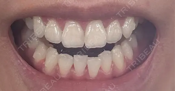 矯正（マウスピース） 湘南歯科クリニック 池袋院 DAY 104 メイン用