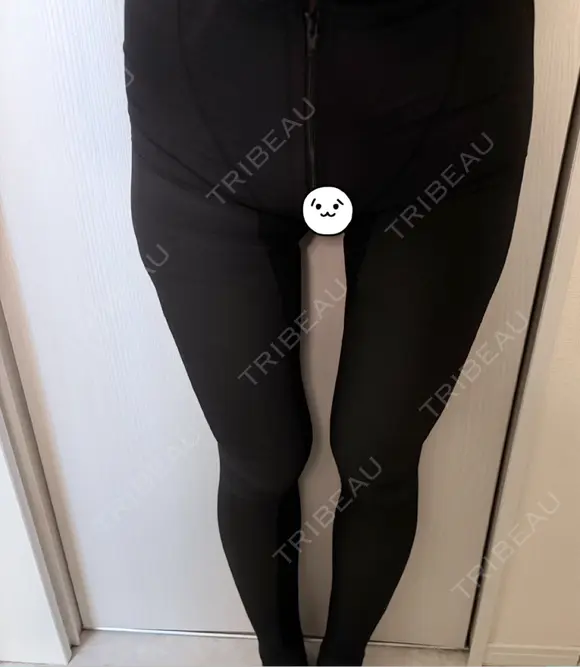 脂肪吸引（脚） / 脂肪吸引（お尻） アムルーズ美容外科クリニック 横浜院 DAY 1 メイン用