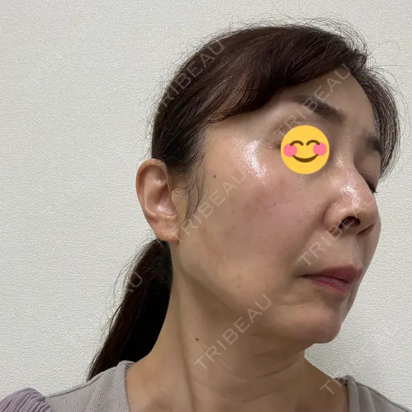 ポテンツァ BAO CLINIC 神戸院 DAY 2 メイン用