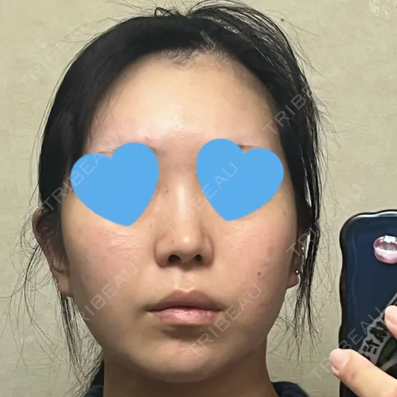 鼻尖形成（切開） / 小鼻縮小（切開） / 脂肪吸引（顔） / 軟骨移植 / 骨切幅寄せ / 鼻尖縮小 / 鼻柱挙上 銀座マイアミ美容外科 AFTER メイン用