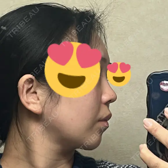 鼻尖形成（切開） / 小鼻縮小（切開） / 脂肪吸引（顔） / 軟骨移植 / 骨切幅寄せ / 鼻尖縮小 / 鼻柱挙上 銀座マイアミ美容外科 DAY 713 メイン用