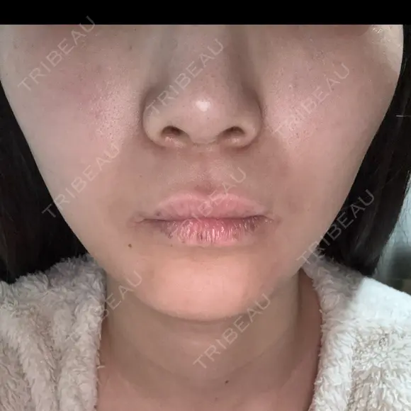 メーラーファット除去 / ハイフ（顔） A CLINIC（エークリニック） 新宿院 AFTER メイン用