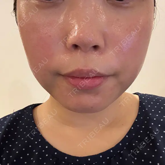 脂肪溶解注射（顔） BAO CLINIC 神戸院 DAY 0 メイン用