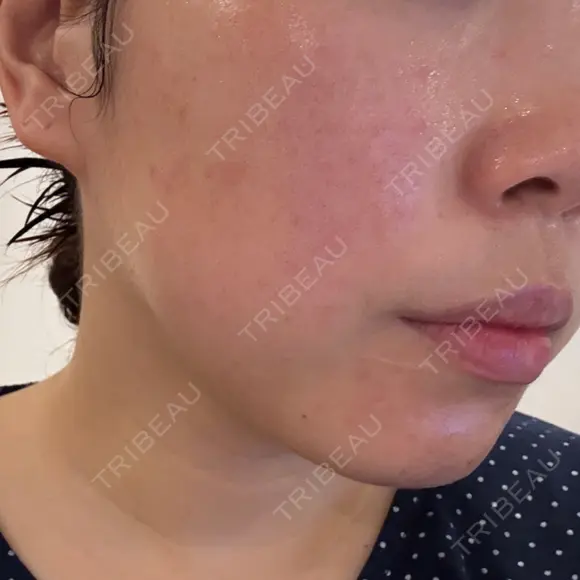 脂肪溶解注射（顔） BAO CLINIC 神戸院 DAY 0 メイン用