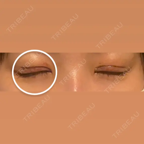 二重切開 / 眼瞼下垂（切開） / 上まぶたたるみ取り eクリニック 福岡院 DAY 5 メイン用