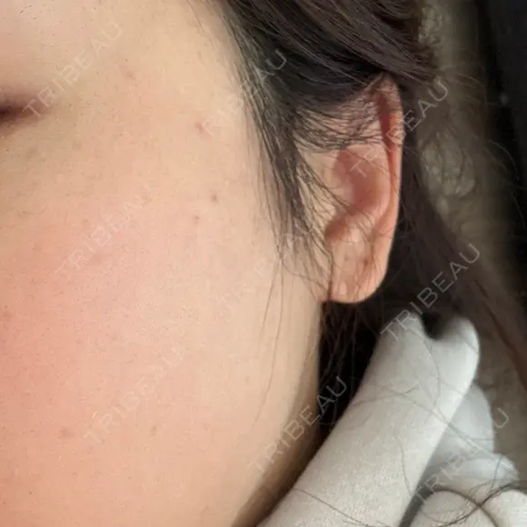 ルメッカ おおかみ美容のクリニック 新宿院 AFTER メイン用