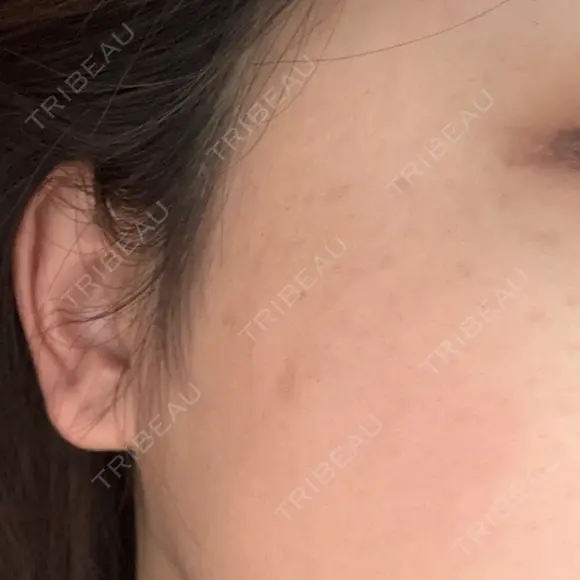 ルメッカ おおかみ美容のクリニック 新宿院 DAY 6 メイン用