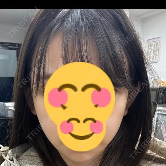 ボトックス（エラ・小顔） L‘amour clinic Tokyo【ラムールクリニック東京】 AFTER メイン用