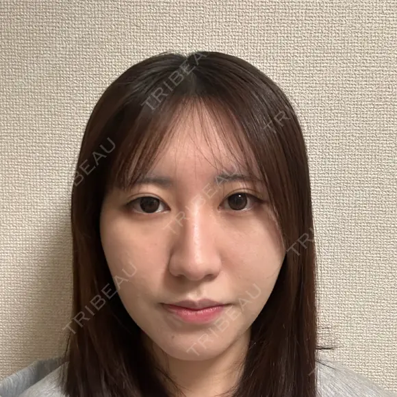 糸リフト / バッカルファット除去 / 脂肪吸引（顔） / メーラーファット除去 / ジョールファット除去 / ボトックス（あご） First Clinic AFTER メイン用