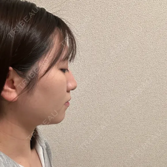 糸リフト / バッカルファット除去 / 脂肪吸引（顔） / メーラーファット除去 / ジョールファット除去 / ボトックス（あご） First Clinic DAY 91 メイン用