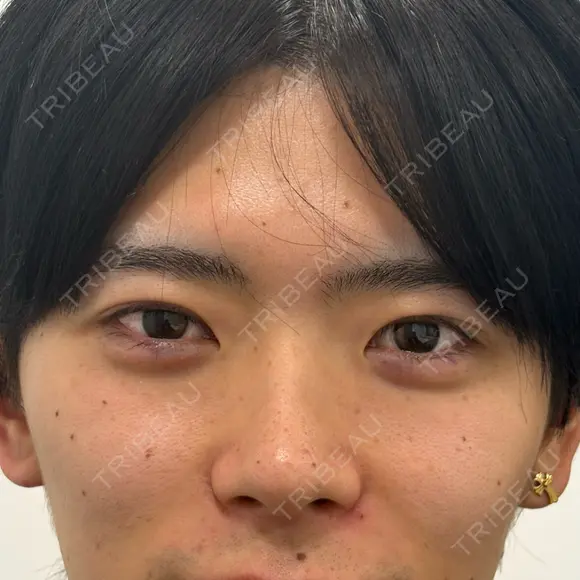 ヒアルロン酸注入（涙袋） / ボトックス（エラ・小顔） 新未来クリニック AFTER メイン用