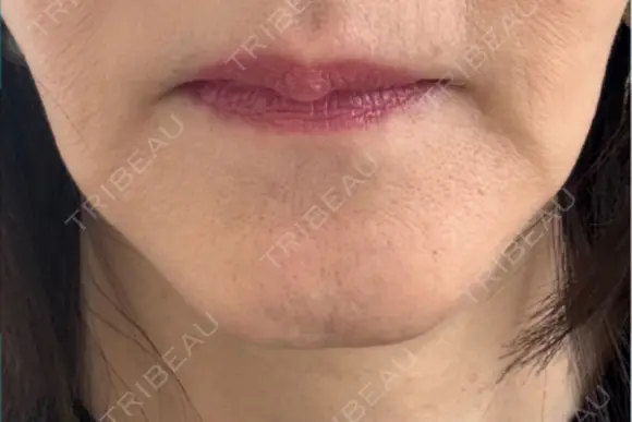 PRP皮膚再生療法 ノリス美容クリニック AFTER メイン用