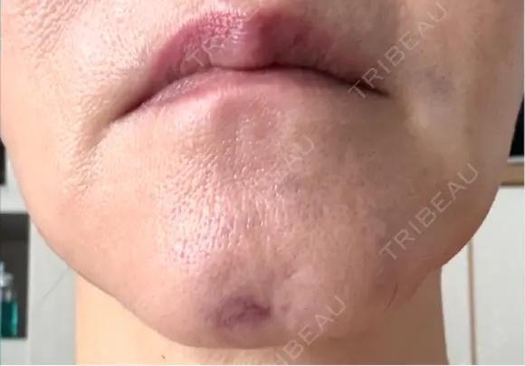 PRP皮膚再生療法 ノリス美容クリニック DAY 1 メイン用