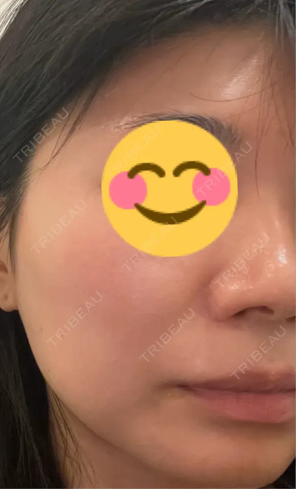 ボトックス（あご） / ボトックス（エラ・小顔） / シワ取りボトックス / ボトックス（眉間） LE CLINIC DAY 0 メイン用