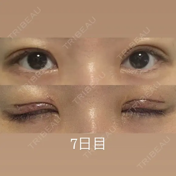 二重切開 / 眼瞼下垂（切開） / 上まぶたたるみ取り eクリニック 福岡院 DAY 6 メイン用