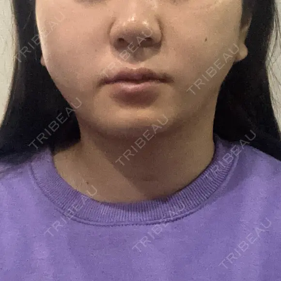 糸リフト / 脂肪吸引（顔） / ジョールファット除去 Wing clinic 豊中駅前院 DAY 1 メイン用