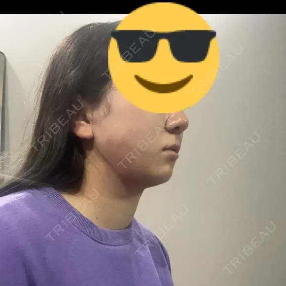 糸リフト / 脂肪吸引（顔） / ジョールファット除去 Wing clinic 豊中駅前院 DAY 1 メイン用