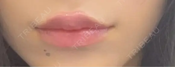 シワ取りボトックス 東京シルククリニック 新宿院 AFTER メイン用