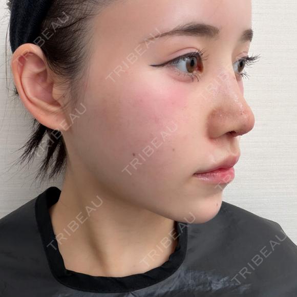 隆鼻術 / 軟骨移植 / 鼻尖形成（非切開） / 鼻中隔延長（非切開） WOM CLINIC GINZA （ワム クリニック ギンザ） DAY 8 メイン用