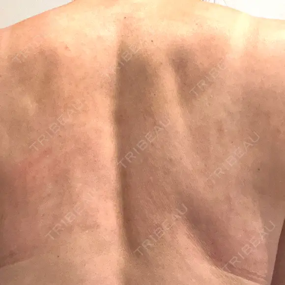 ピコフラクショナルレーザー（毛穴・ニキビ跡） ルラ美容クリニック 広島院 DAY 4 メイン用