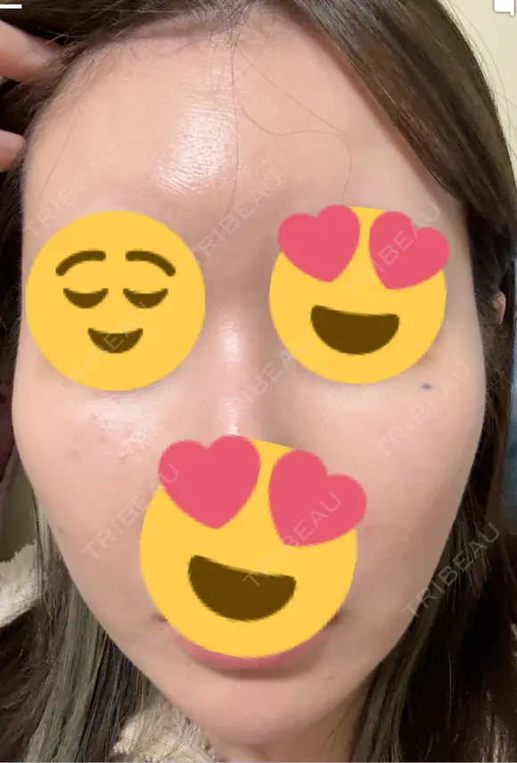 フラクショナルレーザー（毛穴・ニキビ跡） おおかみ美容のクリニック 新宿院 DAY 1 メイン用